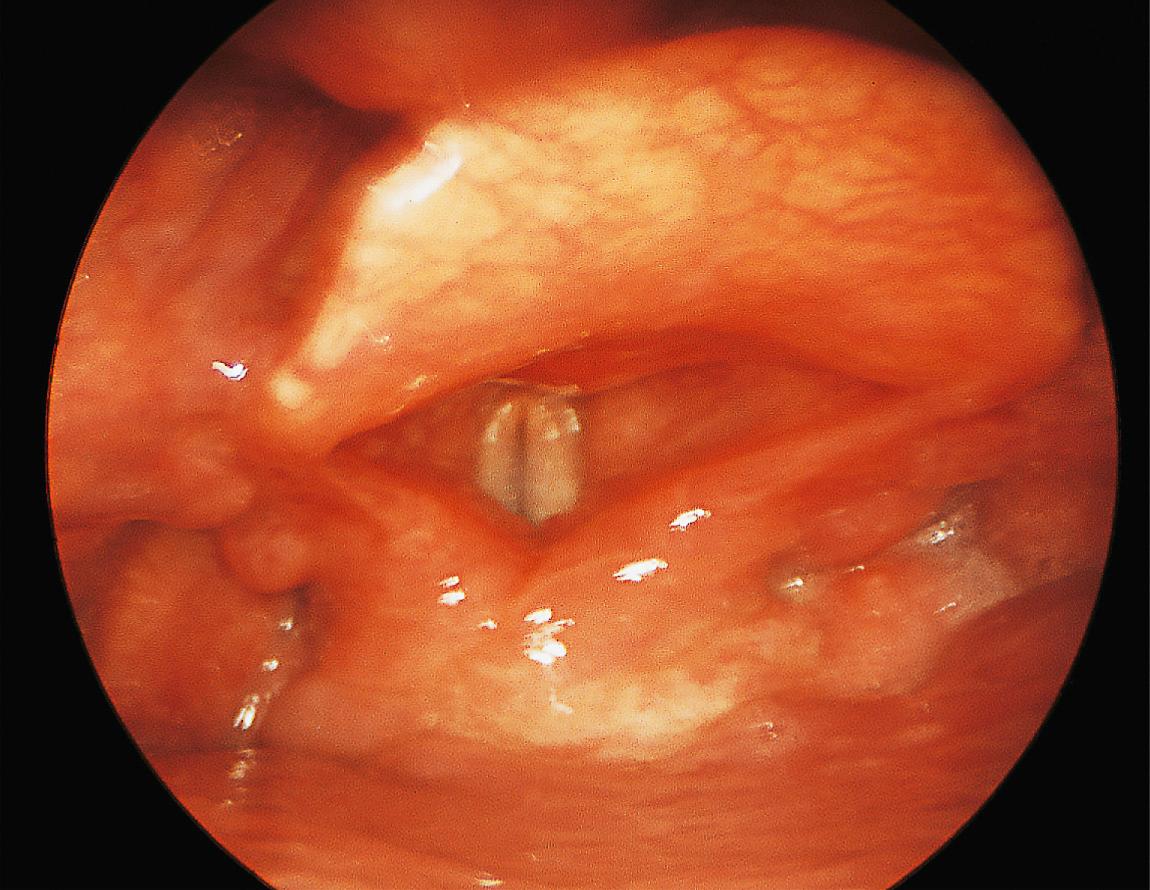 Figure 9.26, A postcricoid carcinoma.