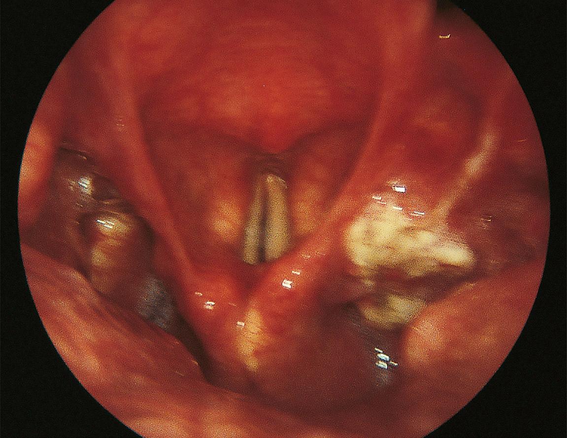 Figure 9.27, A localized tumor of the medial wall of the right pyriform sinus.