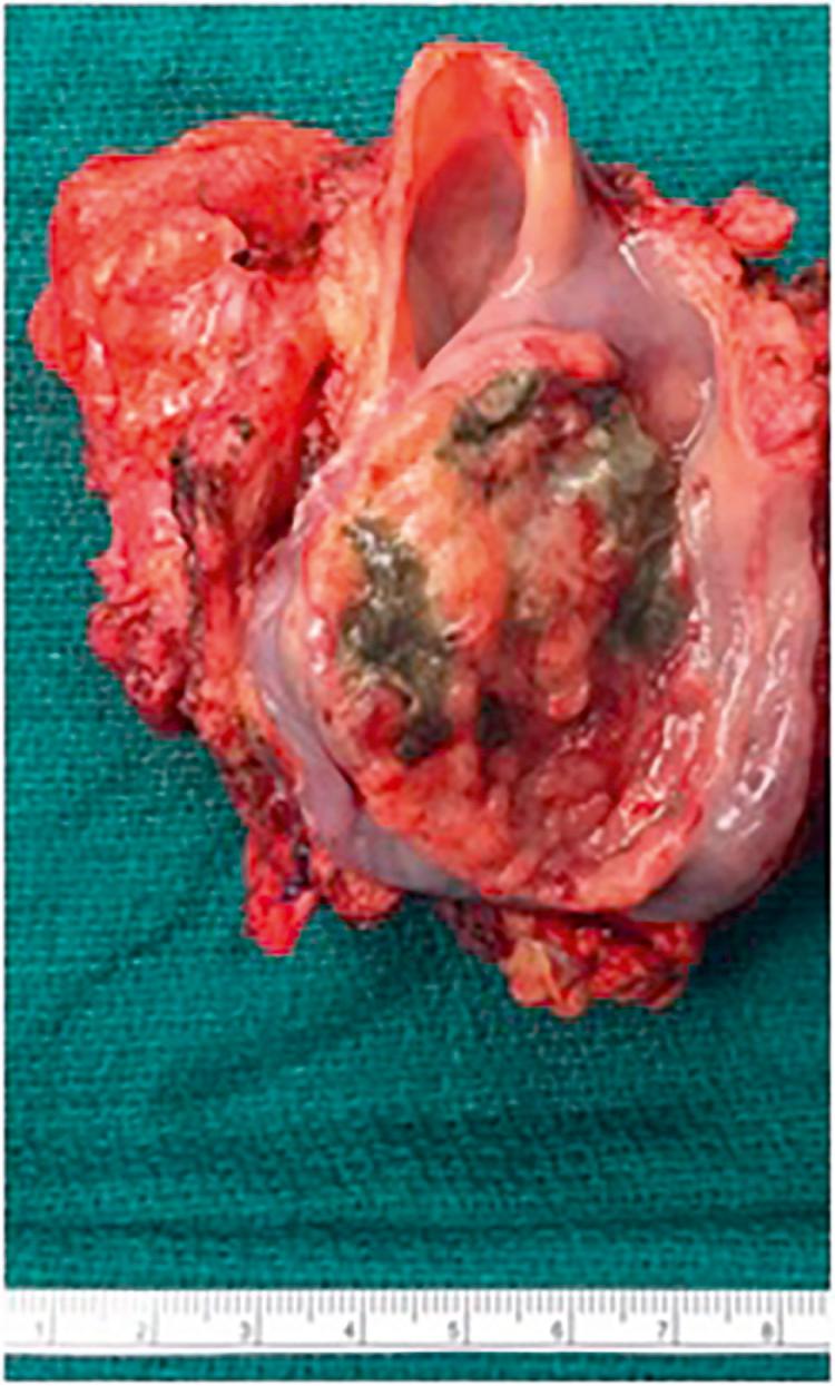 Figure 9.28, Surgical specimen of locally advanced carcinoma of the pyriform sinus extending into cervical esophagus.