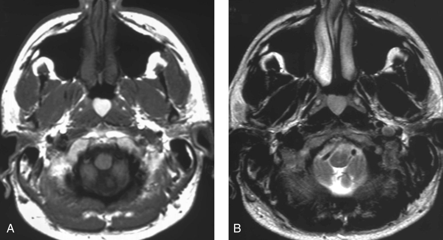 Figure 9.29, A Thornwaldt cyst of the nasopharynx. A , A T1-weighted magnetic resonance imaging scan showing a well-defined midline submucosal lesion of the nasopharynx located between the longus colli muscles. The lesion is T1 bright because of its high protein content. B , This lesion has an intermediate signal on T2-weighted MRI, but the signal can vary depending on the protein content of the lesion.