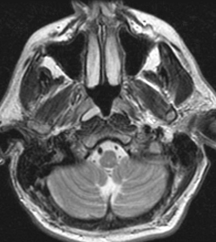 Figure 9.30, A T2-weighted magnetic resonance imaging scan showing a well-defined hyperintense retention cyst in the right fossa of Rosenmüller.