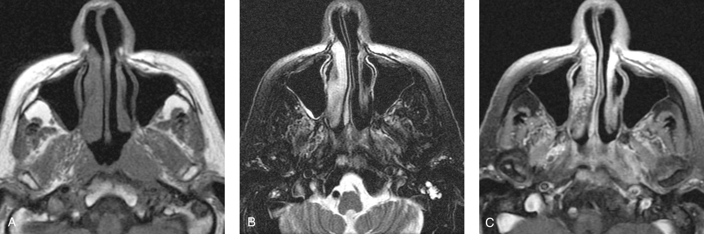 Figure 9.31, Invasion of the clivus by a nasopharyngeal carcinoma seen on a magnetic resonance imaging (MRI) scan. A , An axial precontrast T1-weighted MRI scan showing a grayish tumor infiltrating normal bright adult fatty marrow. B , The tumor has a high signal on T2-weighted MRI. C , The tumor enhances on a postcontrast T1-weighted MRI scan.