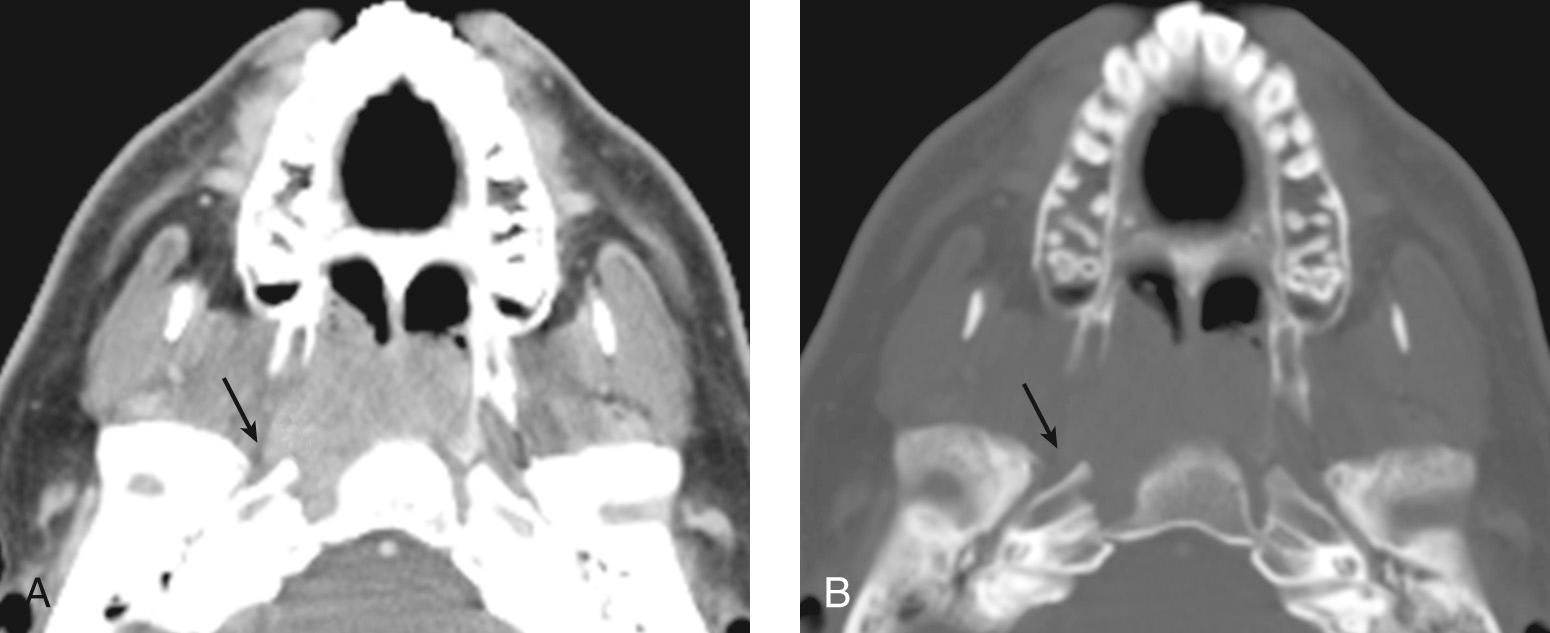 Figure 9.32, A computed tomography scan. A , Soft tissue. B , Bone window showing widening of the petroclival fissure by a nasopharyngeal carcinoma ( arrow ).