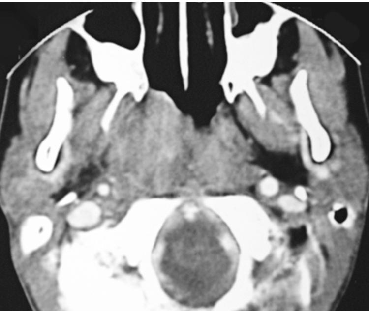 Figure 9.33, An axial postcontrast computed tomography scan showing invasion of the right parapharyngeal space by a nasopharyngeal carcinoma.