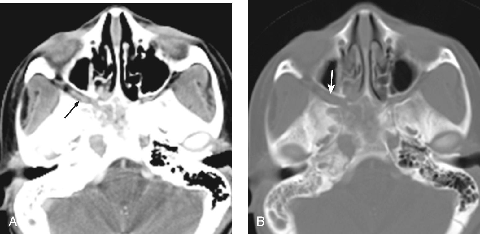 Figure 9.34, An axial postcontrast computed tomography scan. A , Arrow shows abnormal soft tissue in the right pterygopalatine fossa on the soft-tissue window. B , Arrow shows widening of the bony right pterygopalatine fossa on the bone window.