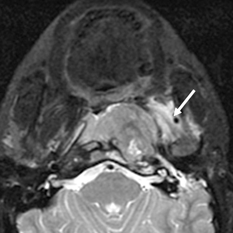 Figure 9.35, A T2-weighted magnetic resonance imaging scan showing involvement of the left masticator space by a nasopharyngeal carcinoma. Arrow indicates tumor extension.