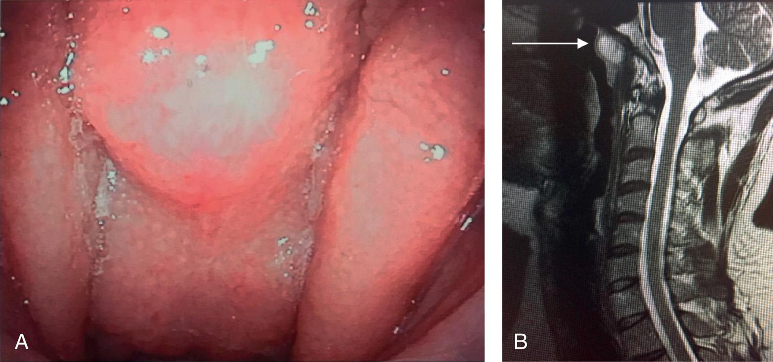 Figure 9.8, A Thornwaldt cyst of the nasopharynx, nasal endoscopic view (A) and T2 weighted sagittal MRI showing the cyst in the posterior wall of the nasopharynx (B) .