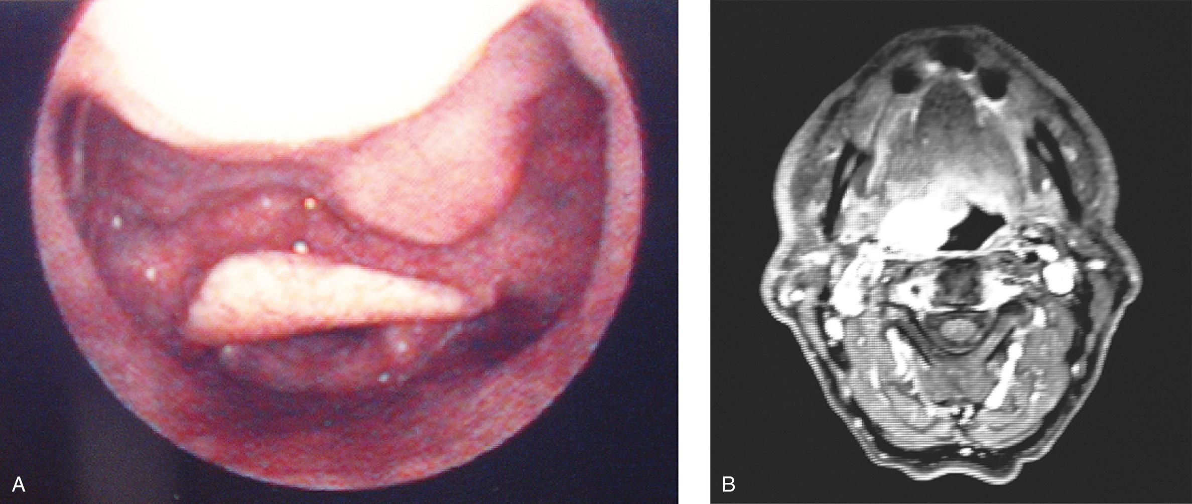 Figure 9.36, A minor salivary gland tumor of the right base of the tongue. A , Endoscopic view. B , Postcontrast, T1-weighted magnetic resonance imaging scan shows contrast-enhancing tumor of the right base of the tongue.