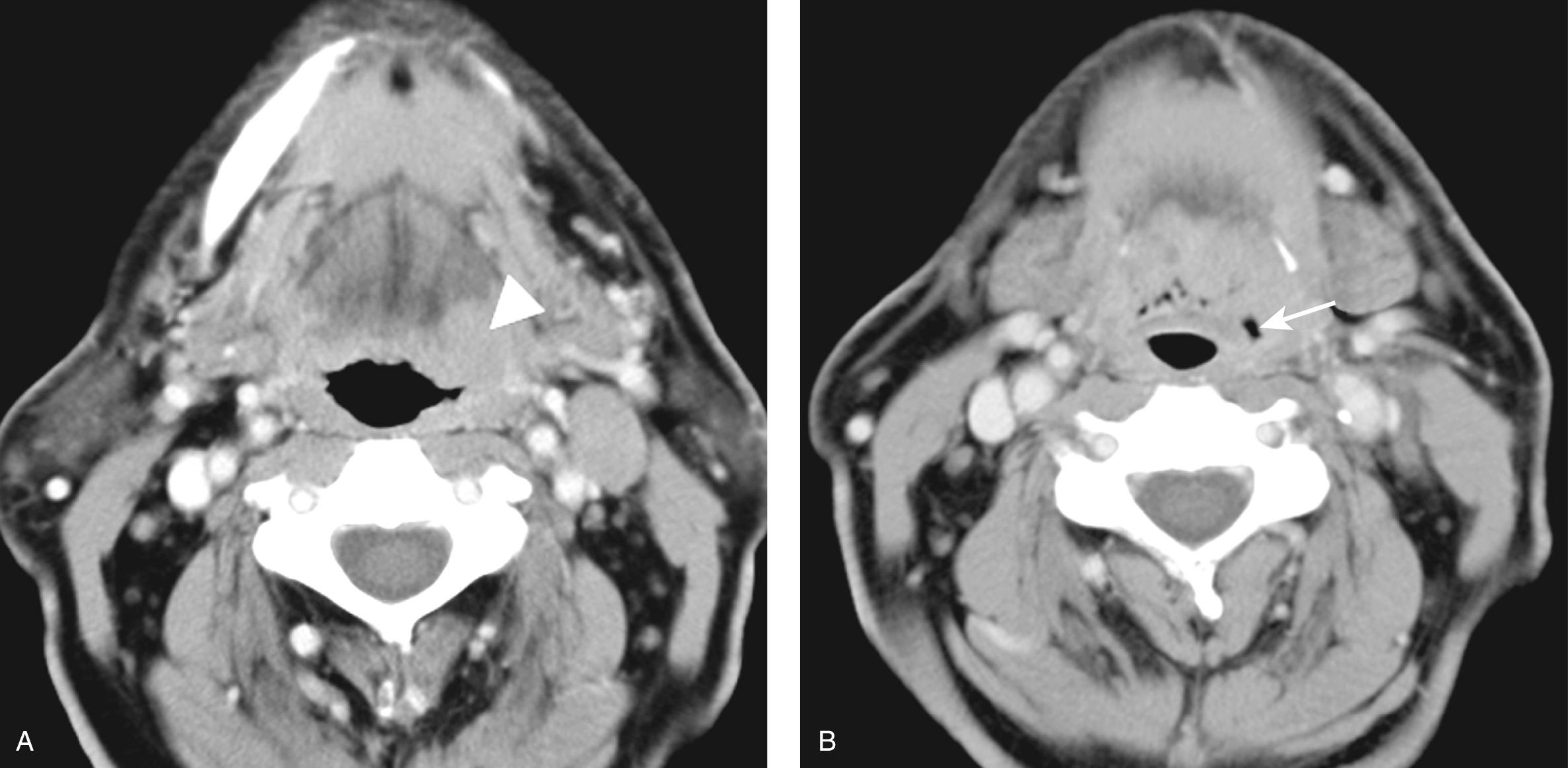Figure 9.37, A contrast-enhanced computed tomography scan showing spread of a tumor ( A ) at the left base of the tongue ( arrowhead ) and ( B ) laterally to the lateral pharyngeal wall ( arrow ).