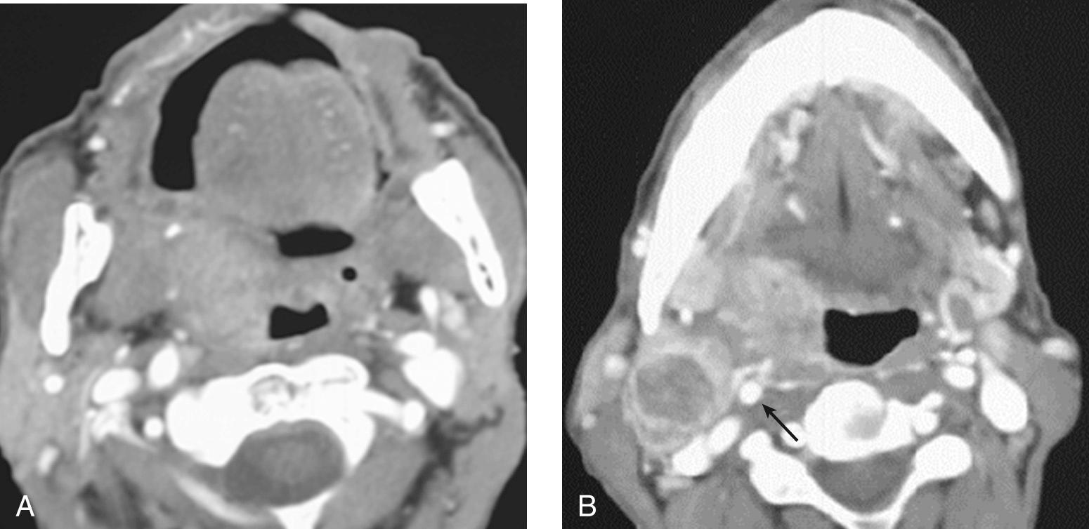 Figure 9.38, Patterns of spread of a tonsillar carcinoma shown on a computed tomography scan. A , Invasion of the right soft palate. B , Involvement of the base of the tongue. Note the location of the right internal carotid artery shown by the arrow between the primary tumor and the necrotic right level II lymph node. The artery is at risk for encasement or involvement by advanced tonsil cancer.