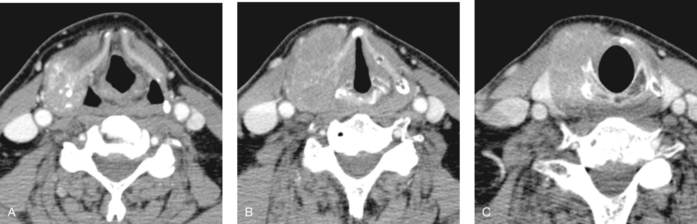 Figure 9.41, A contrast-enhanced computed tomography scan showing ( A ) a locally advanced tumor of the right pyriform sinus that has ( B ) destroyed the posterior aspect of the lamina of the right thyroid cartilage and ( C ) the right half of the cricoid cartilage with obvious extralaryngeal soft-tissue extension.