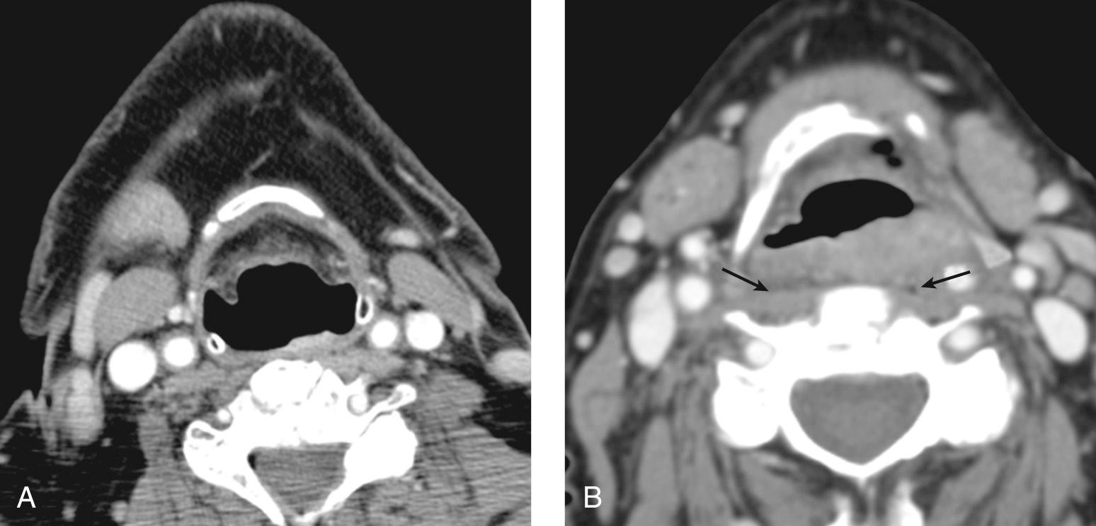 Figure 9.42, A carcinoma of the posterior pharyngeal wall seen on a contrast-enhanced computed tomography scan. A , Early tumor of the left posterior pharyngeal wall. B , Obvious abnormal thickening and enhancement of the posterior pharyngeal wall in a more advanced tumor. Note the presence of a fat plane ( arrows ) overlying the prevertebral musculature.