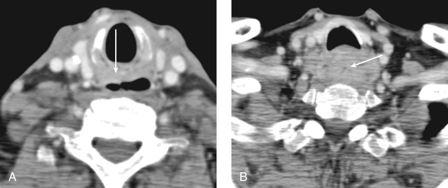 Figure 9.43, A contrast-enhanced computed tomography scan showing ( A ) abnormal soft tissue thickening of the postcricoid hypopharynx ( arrow ) and ( B ) circumferential extension caudad into the cervical esophagus ( arrow shows esophageal lumen).