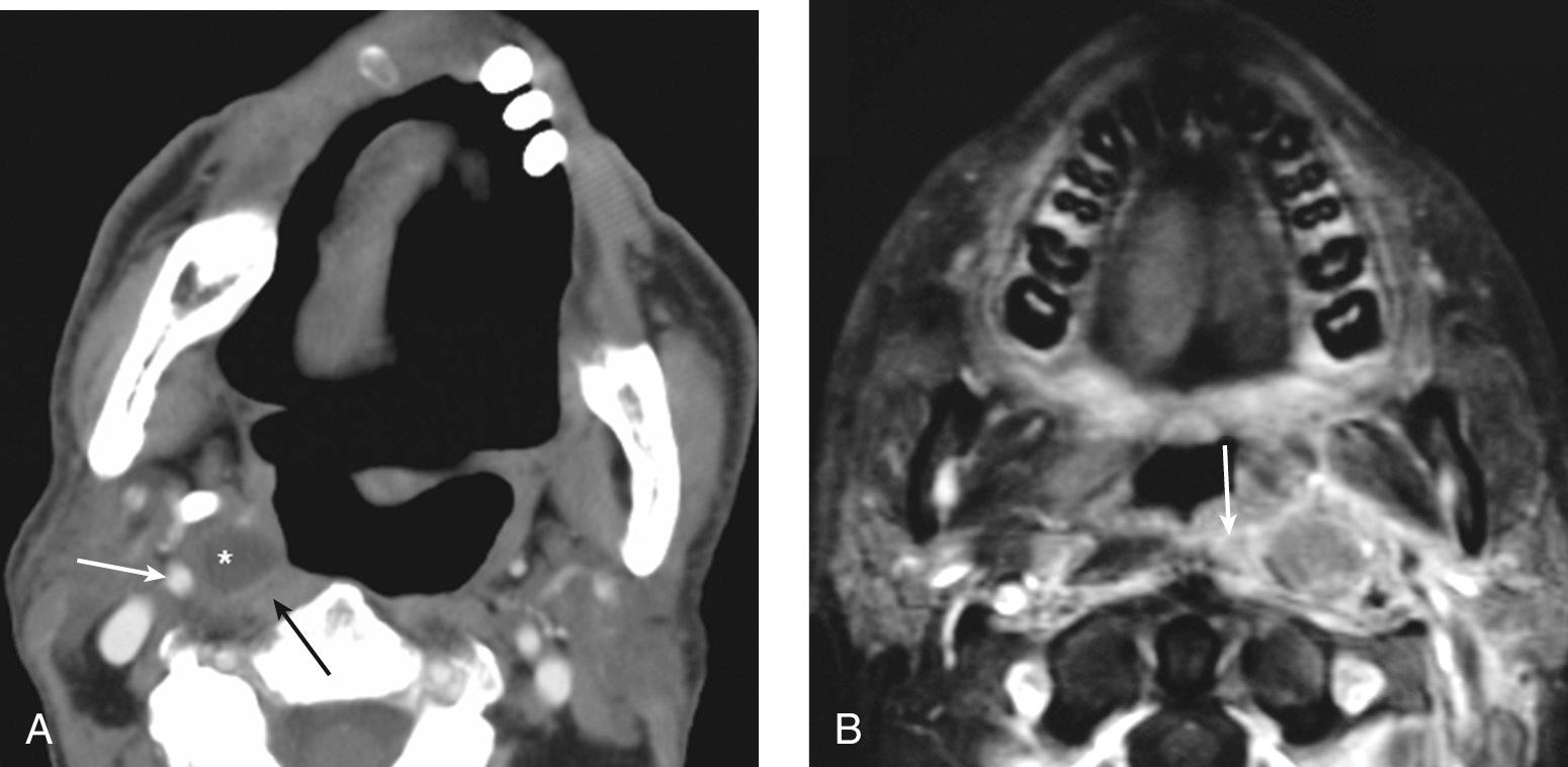 Figure 9.44, Lateral retropharyngeal lymphadenopathy. A , Contrast-enhanced computed tomography scan showing a cystic right lateral retropharyngeal lymph node from a primary tonsil squamous cell carcinoma. Note the location of the lymph node ( * ) between the prevertebral musculature ( black arrow ) and the internal carotid artery ( white arrow ). B , A postcontrast axial T1-weighted fat-saturated magnetic resonance imaging scan showing a metastatic left retropharyngeal node from a nasopharyngeal primary tumor. The prevertebral musculature ( white arrow ) is infiltrated by extracapsular spread from the retropharyngeal lymph node.