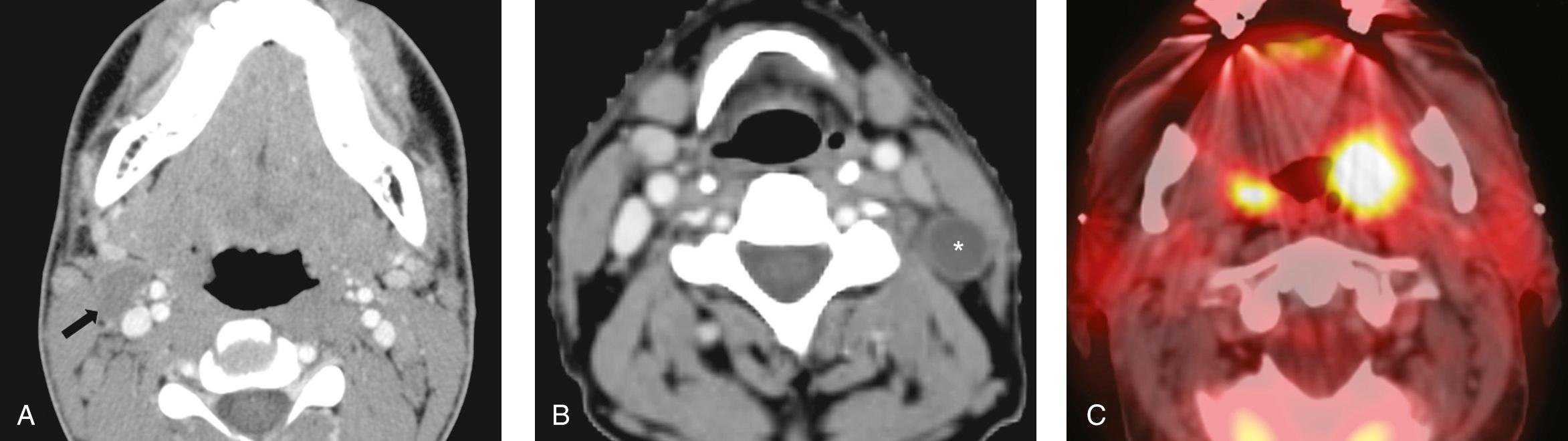 Figure 9.45, A , A contrast-enhanced computed tomography scan showing a cystic homogeneous mass with a thin nonenhancing rim ( arrow ) in a young male patient indicative of a branchial cleft cyst of the right neck. B , A computed tomography simulation film showing a cystic mass with an enhancing rim ( * ) in the left side of the neck consistent with cystic nodal metastasis. This patient had bilateral cystic nodal metastases from a primary carcinoma of the left tonsil evident on a positron emission tomography scan ( C ).