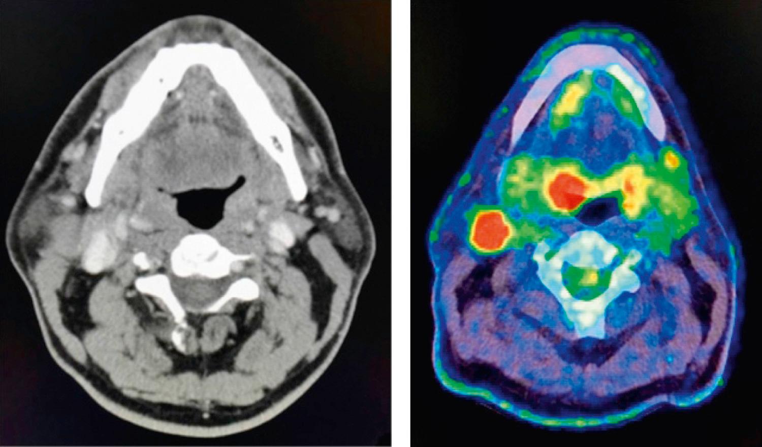 Figure 9.46, Pretreatment imaging with a contrast-enhanced CT scan and a PET scan for carcinoma of the tonsil.