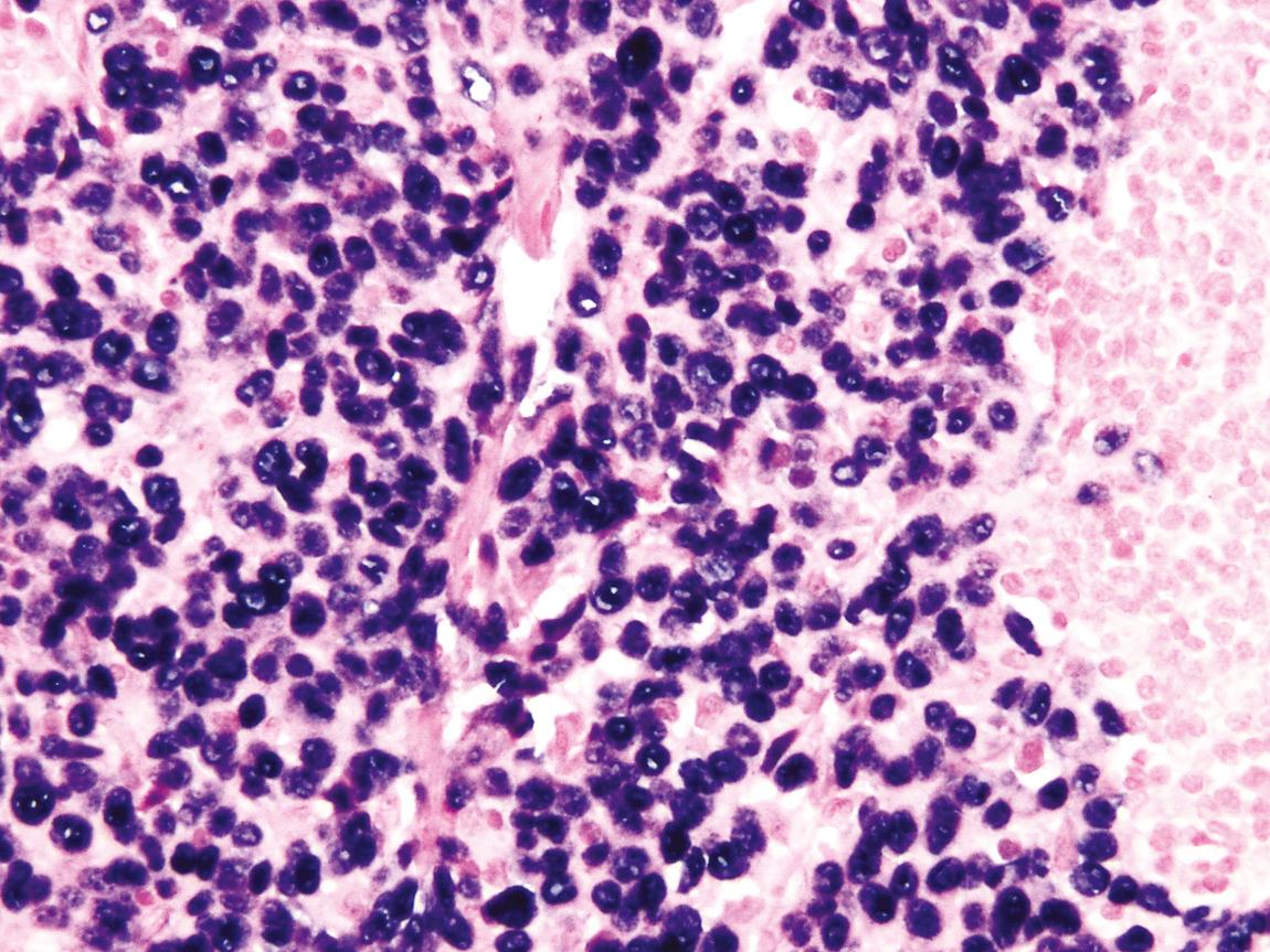 Figure 9.47, Epstein-Barr virus–encoded ribonucleic acid in situ hybridization showing strong nuclear labeling of tumor for Epstein-Barr virus in nasopharyngeal carcinoma.