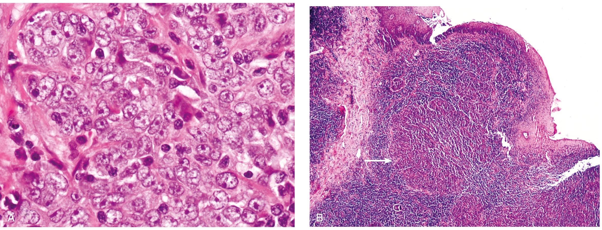 Figure 9.48, Undifferentiated nasopharyngeal carcinoma. A , Tumor cells growing in a nested, syncytial pattern with indistinct cell borders, open chromatin, and prominent nucleoli. (Hematoxylin-eosin stain; ×400.) B , Abundant lymphoid infiltrate that obscures nests of tumor cells ( arrow ). (Hematoxylin-eosin stain; ×100.)