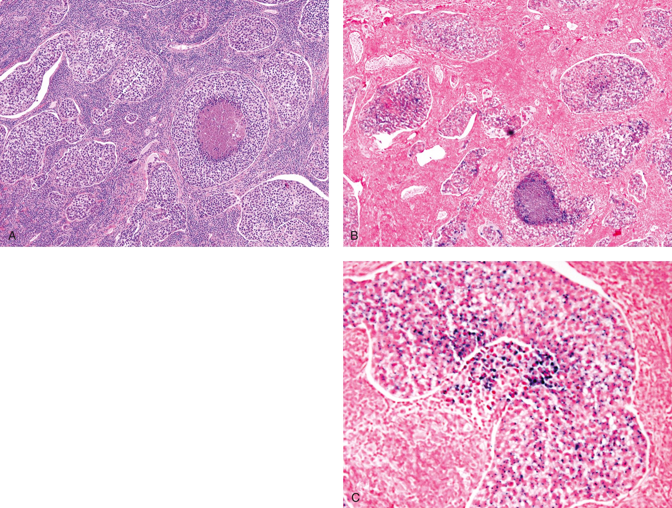 Figure 9.49, Oropharyngeal squamous cell carcinoma. A , Islands of squamous cell carcinoma involving the tonsil. (Hematoxylin-eosin stain.) B , Low-power view of human papillomavirus in situ hybridization with a probe that covers multiple high-risk serotypes, including human papillomavirus 16 and 18. C , Higher magnification demonstrates dot-like nuclear positivity.