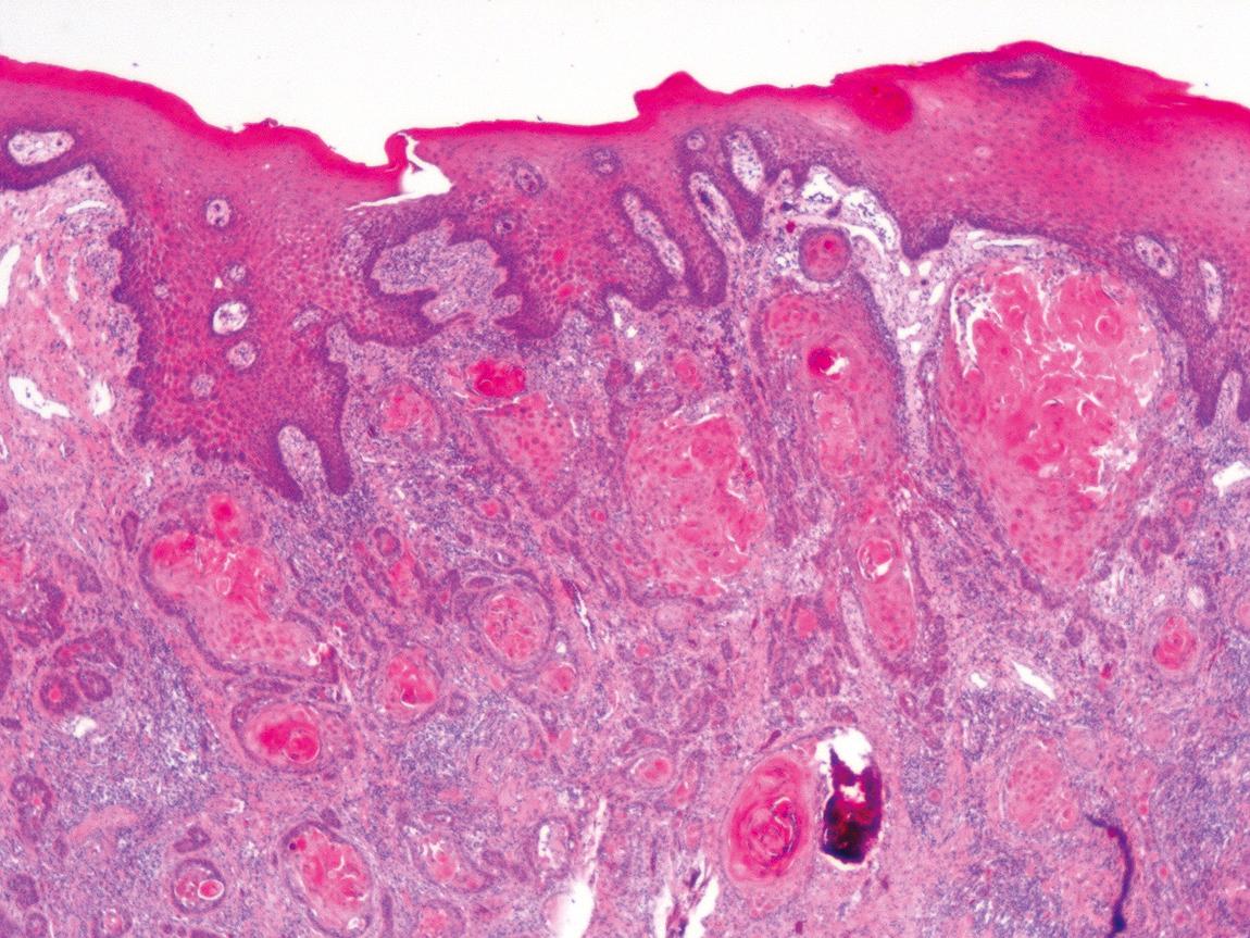 Figure 9.50, Submucosal extension of tumor in a hypopharyngeal squamous cell carcinoma (hematoxylin-eosin stain).