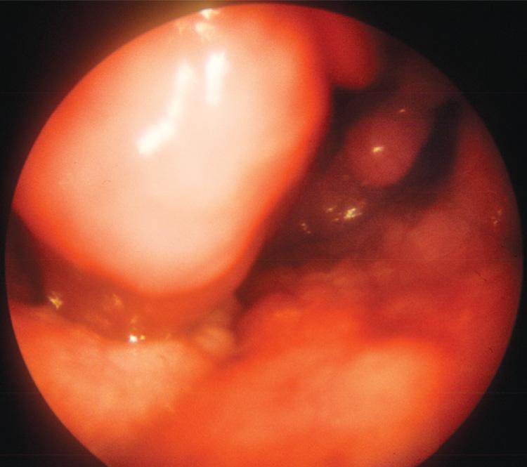 Figure 9.10, A plasmacytoma of the nasopharynx.