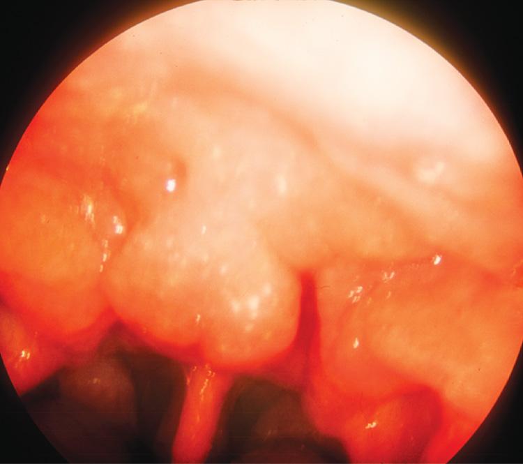 Figure 9.11, A hypertrophic adenoid in the nasopharynx.