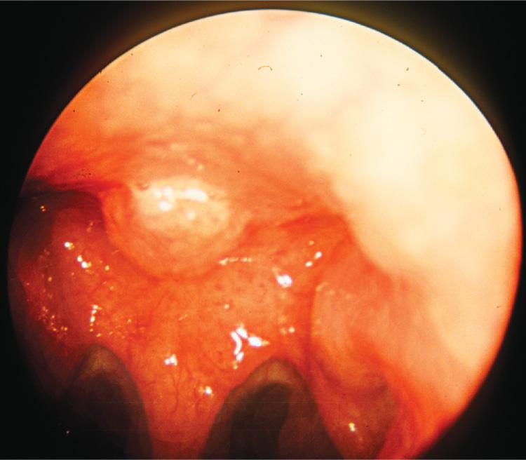 Figure 9.12, A squamous cell carcinoma of the roof of the nasopharynx.