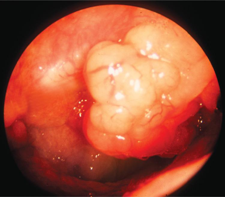 Figure 9.13, A squamous cell carcinoma of the lateral wall of the nasopharynx.