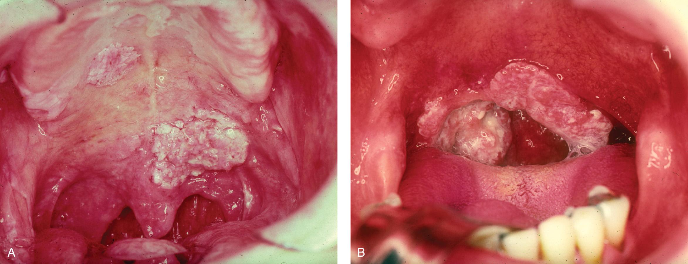 Figure 9.15, Squamous cell carcinomas of the soft palate. A , Early stage. Two separate lesions of the hard and soft palate. B , Advanced stage.