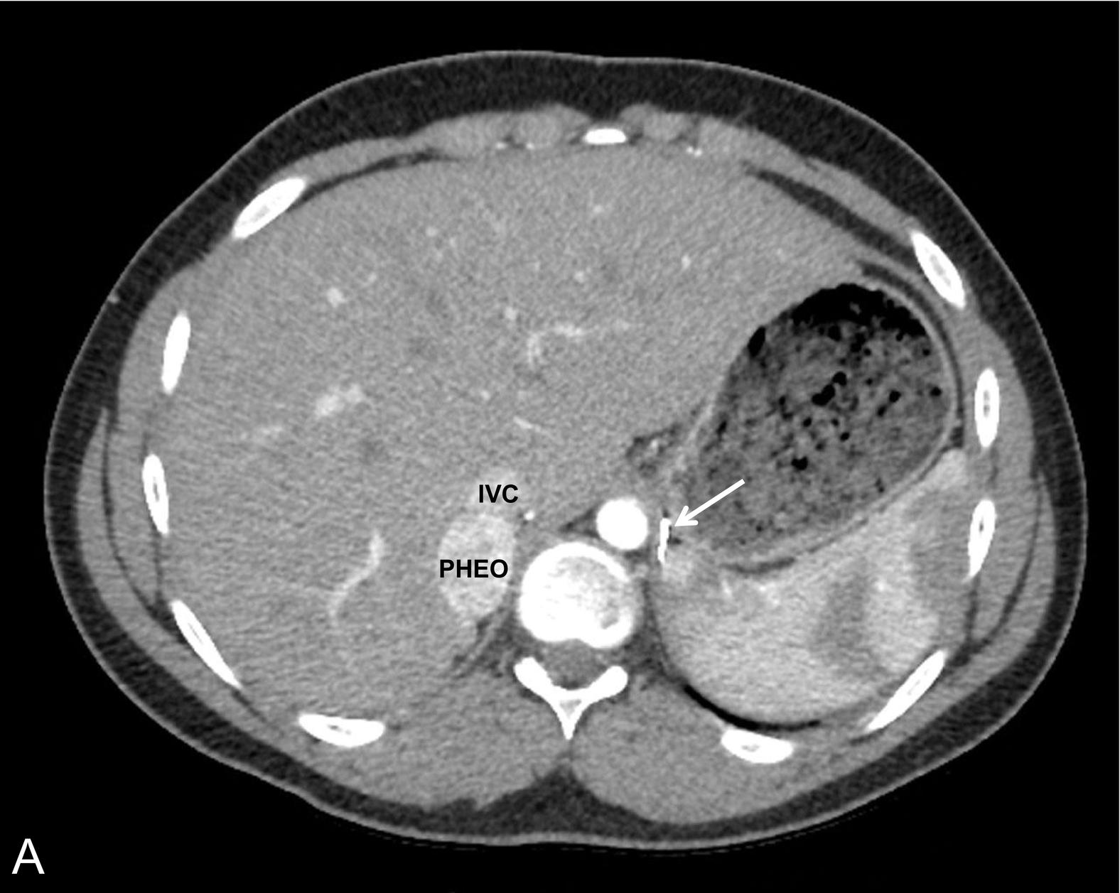 Fig. 15.1, A normotensive 14-year-old male with von Hippel-Lindau disease and a history of a left pheochromocytoma and abdominal paraganglioma diagnosed at the age of 7 years was found to have elevated normetanephrine levels after screening. Axial computed tomography (CT) postcontrast (A) with coronal reconstruction (B) identified a vascular neoplasm arising from the superior right adrenal gland ( arrow , surgical clips from previous adrenalectomy). Metaiodobenzylguanidine (MIBG) scan confirmed the functional nature of the tumor and ruled out other synchronous tumors. Planar (C) and fused single photon emission CT/CT axial images (D) in the same patient, 24 hours after the administration of 123 I MIBG. IVC , Inferior vena cava; PHEO , pheochromocytoma.