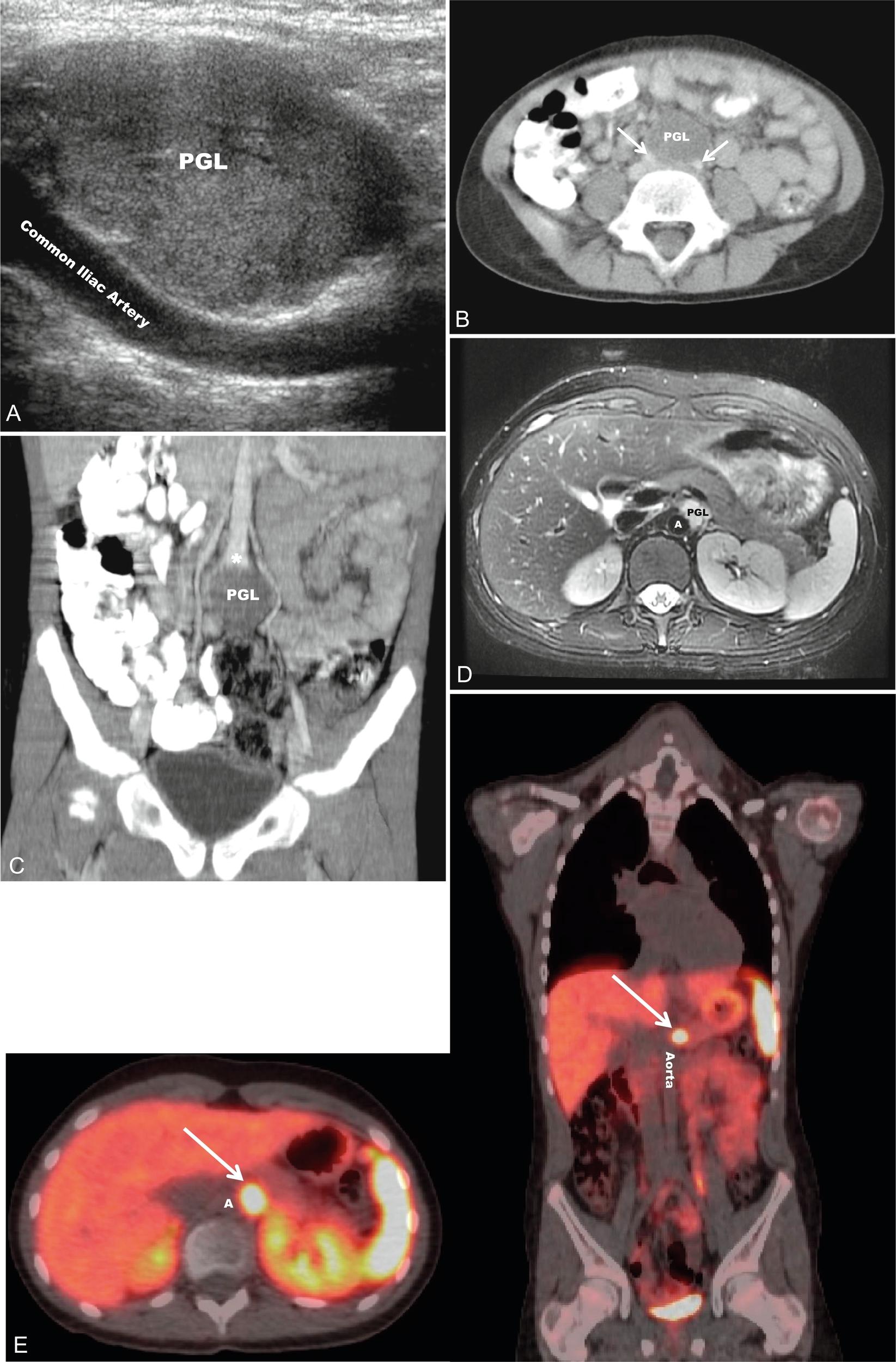 Fig. 15.2, A 6-year-old female with a paraganglioma (PGL) and an SDHB mutation presented with severe hypertension during a well-child examination. A, Abdominal ultrasound (sagittal view) revealed a homogeneous, hypervascular 3.3-cm mass next to the common iliac arteries. Axial computed tomography (CT) postcontrast (B) ( arrows , common iliac arteries) with coronal reconstruction (C) confirmed a tumor at the aortic bifurcation (asterisk) . A 13-year-old boy with an SDHB mutation developed elevated blood pressures and abnormal norepinephrine, normetanephrine, and chromogranin A levels during prospective screening. T2-weighted axial images from abdominal magnetic resonance imaging (D) revealed a 2-cm paraaortic mass (PGL) between the origins of the celiac axis and superior mesenteric artery that was T2 hyperintense. This was subsequently confirmed via functional imaging with 68Ga-DOTATATE positron emission tomography/CT (E) to be a paraganglioma ( arrows ). A, Aorta.