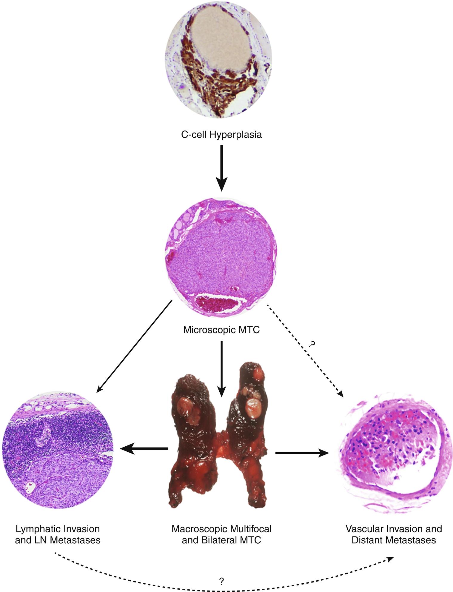 Fig. 15.6, A germline RET mutation causes C-cell hyperplasia, the initial stage in an oncologic cascade that ultimately leads to the development of microscopic noninvasive MTC and possibly lymph node and distant metastatic disease caused by frankly invasive carcinoma. The weight of the arrows denotes the hypothetical probability of the event occurring in the typical pediatric patient with a RET codon 634 mutation. LN , Lymph node; MTC , medullary thyroid carcinoma.