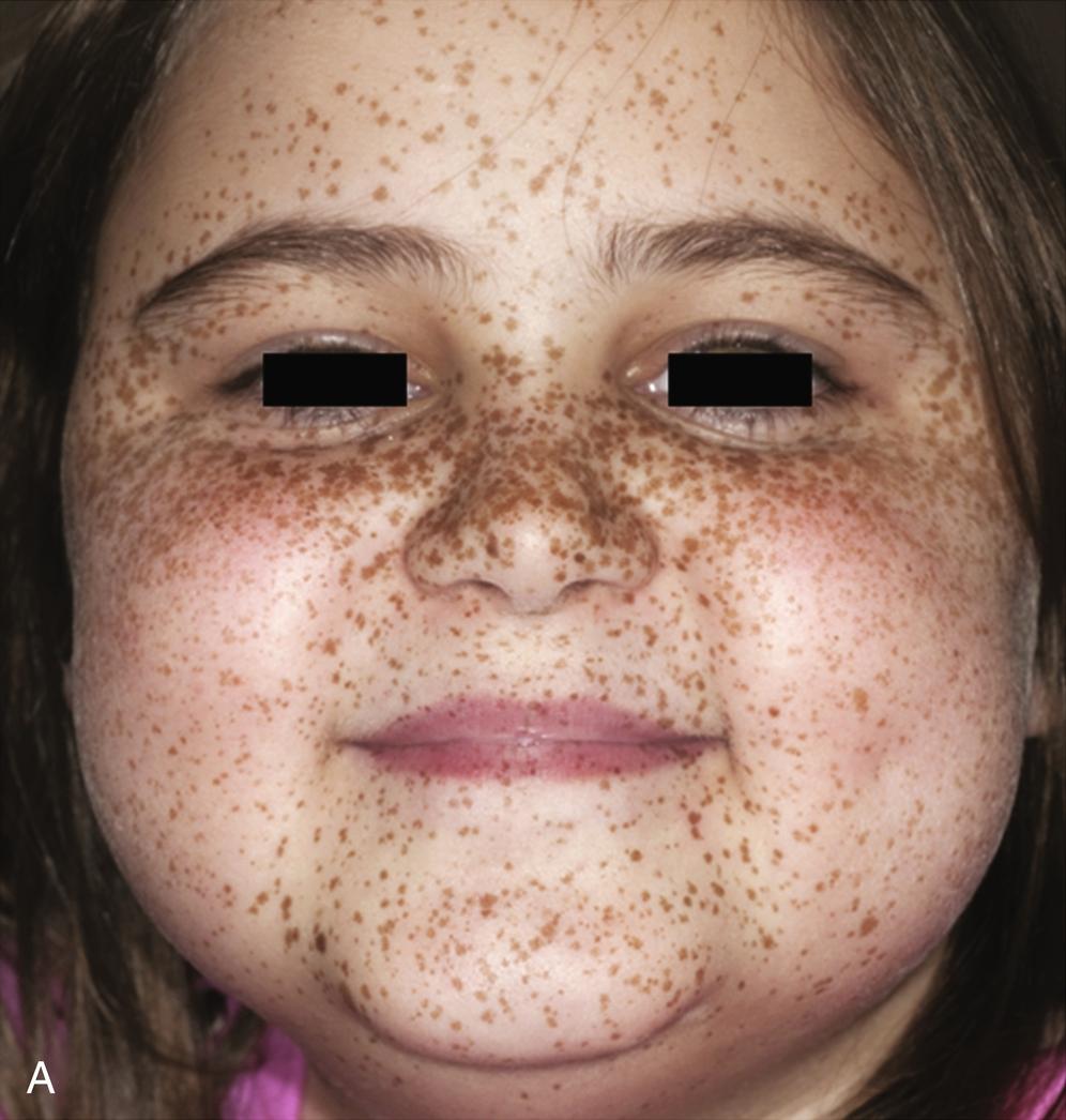 Fig. 15.7, Carney complex and primary pigmented nodular adrenocortical disease (PPNAD). A, A 10-year-old female with adrenocorticotropin hormone (ACTH)-independent Cushing syndrome and the Carney complex demonstrates facial rounding, plethora, and classic facial lentiginosis. B, Gross pathologic specimen of the right adrenal gland in another patient with PPNAD and the Carney complex.