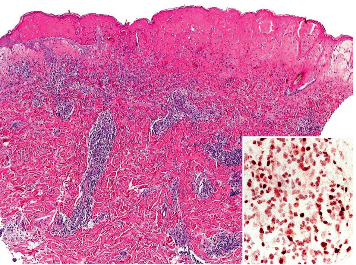 Fig. 87.10, Hydroa vacciniforme – histopathologic features.