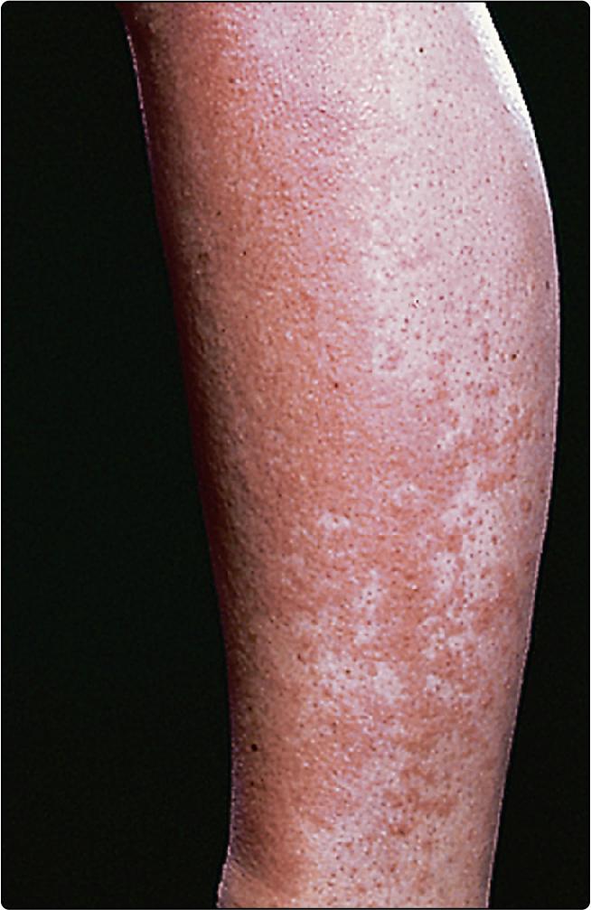 Fig. 26.1, Polymorphic light eruption affecting the lower legs.