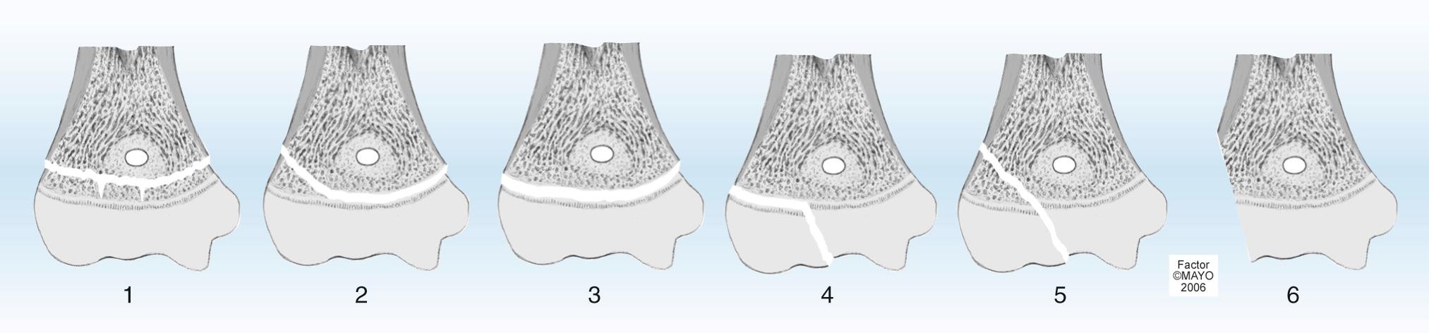 FIG 29.2, Peterson classification of distal humeral physeal fractures.