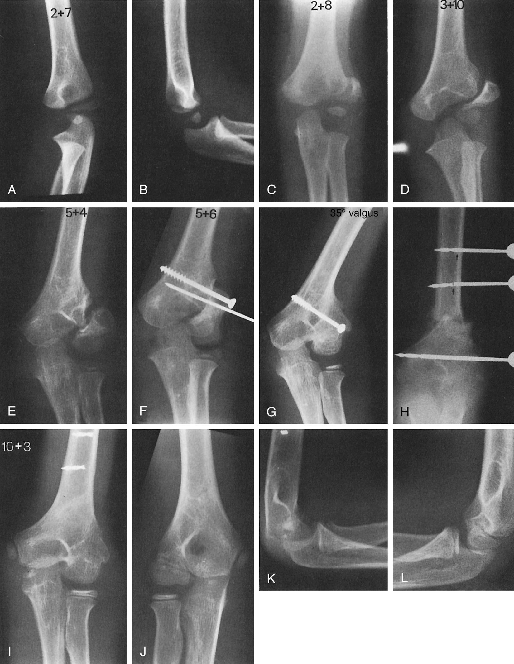 FIG 29.4, A right-dominant boy aged 2 years and 7 months fell off a bunk bed, injuring his left elbow. (A) Oblique roentgenogram shows fracture of the lateral metaphysis. This was regarded to be a type 2 injury, with good prognosis for union and subsequent growth. Note, however, that this could be a type 5 injury (see Fig. 29.2 ), with intraarticular fracture and a poor prognosis. The best way to differentiate these fractures is by arthrography or MRI. (B) Lateral view shows no abnormality. A cast was applied and multiple roentgenograms in the cast over the next month showed maintenance of position. (C) After cast removal 6 weeks later the fragment was ununited and displaced laterally. Motion was begun. (D) Fifteen months after injury; established nonunion. Lateral and proximal displacement of the fragment suggests that this was an intraarticular type 5 injury. (E) Two years and nine months after injury, the patient was referred for treatment. The chief complaint was increasing valgus deformity. No pain or functional impairment. (F) Five weeks after surgical osteosynthesis. (G) Age 6 years and 10 months: union with persistent cubitus valgus. (H) Three weeks postoperative arcuate varus osteotomy. Note fracture of the proximal two Crowe pins ( arrows ) from stress of pins holding the osteotomy. The pins were removed. A cast was applied for an additional 3 weeks. (I) Age 10 years and 3 months: union of lateral condyle with physeal closure. (J) Right elbow comparison. (K) Lateral normal right elbow. (L) Lateral left elbow. Elbow motion; right 5 degrees' hypertension to 145 degrees' flexion; left 5 to 145 degrees. Type two fractures may heal uneventfully at this age, type 5 fractures rarely do. A definitive diagnosis at the time of injury is always important.