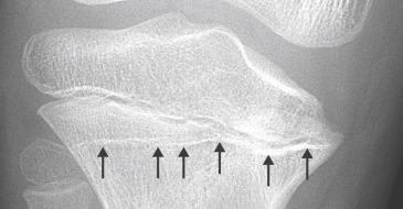 Fig. 2.11, Partial growth arrest confirmed by a Harris growth arrest line (arrows) lying oblique to the proximal tibial physis.