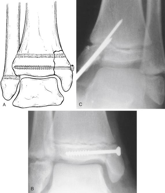 Fig. 2.14, Smooth oblique pins may be used to fix across the physis, although transverse screw or pin fixation avoiding the physis is preferred. (A) A cancellous screw should be placed in the epiphysis only, parallel to the physis. (B) Radiograph showing screw in place. (C) Smooth pins may cross the physis, as in this Salter–Harris type III fracture, even though parallel transverse pins are preferred when possible.(D) At the time of union and pin removal. (E) At 2 years, symmetric growth (note the parallel “injury line” proximally) and no bony bridge formation.