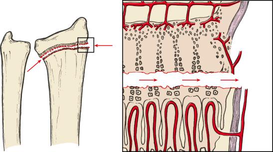 Fig. 2.3, Salter–Harris type I injury with physeal separation through the zone of hypertrophic cells.