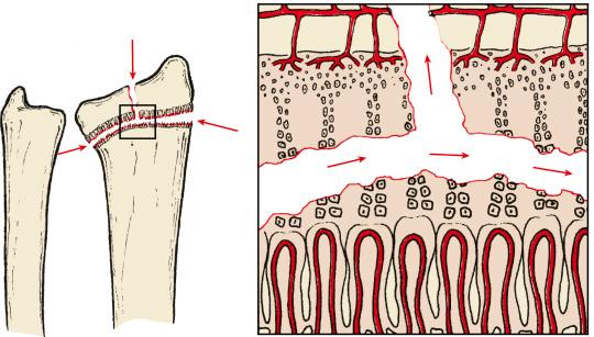 Fig. 2.5, Salter–Harris type III injury with physeal separation and extension across the epiphysis into the joint.