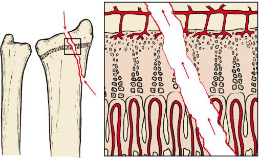 Fig. 2.6, Salter–Harris type IV injury with a metaphyseal spike; the physis and epiphysis are both involved.