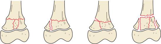 Fig. 2.7, Peterson type I injuries of the metaphysis, with various patterns of extension to the physis.