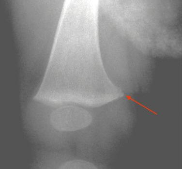 Fig. 2.10, Corner fracture of the distal femoral metaphysis, indicative of a nonaccidental injury.