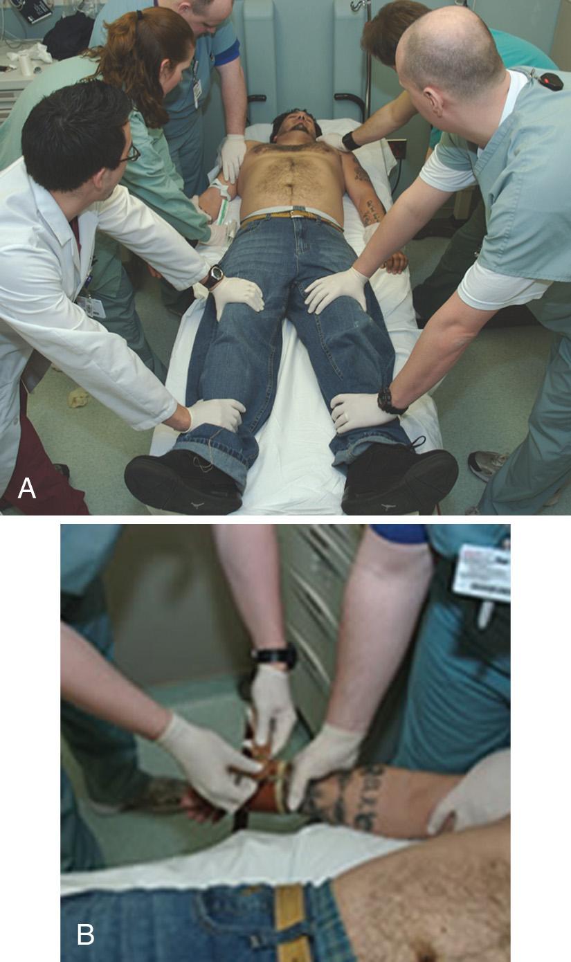 Figure 69.9, Technique to physically restrain a violent patient. Adequate chemical restraint should be used early in the ED course, either before or after physical restraints, to limit acidosis, rhabdomyolysis, and hyperthermia. A, Patients should always be restrained in the supine position. One person is assigned to each limb, which is held firmly against the stretcher by applying direct pressure proximal to the elbows and knees. B, The fifth member of the team places restraints around the wrists and ankles. The limb holders should be applied snugly enough to control movement and prevent escape, but not so tight that they cause pain or impair circulation. If necessary, a fifth-point restraint may be placed across the patient's thighs, pelvis, or chest to further limit motion.