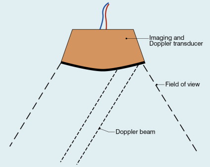 FIGURE 1-2, Duplex system combining real-time B-mode (- - - - ) and a Doppler beam (----) of variable position across the B-mode field of view.