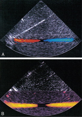 FIGURE 1-3, (A) Colour flow image of flow from left to right in a straight tube. When the flow velocity component is along the beam towards the transducer it is colour-coded red, when the component along the beam is away from the transducer it is coded blue. (B) Power Doppler image of flow in a straight tube. Direction of flow is not measured so it is not colour-coded.