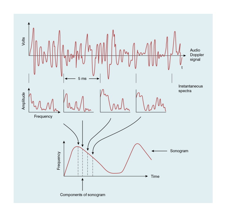 FIGURE 1-5, Schematic representation of the analysis of a Doppler signal to form a sonogram (spectrogram).