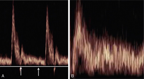 FIGURE 1-6, A normal sonogram (A); (B) a magnified view of the segment between the arrows illustrating the pixel structure and speckle pattern.