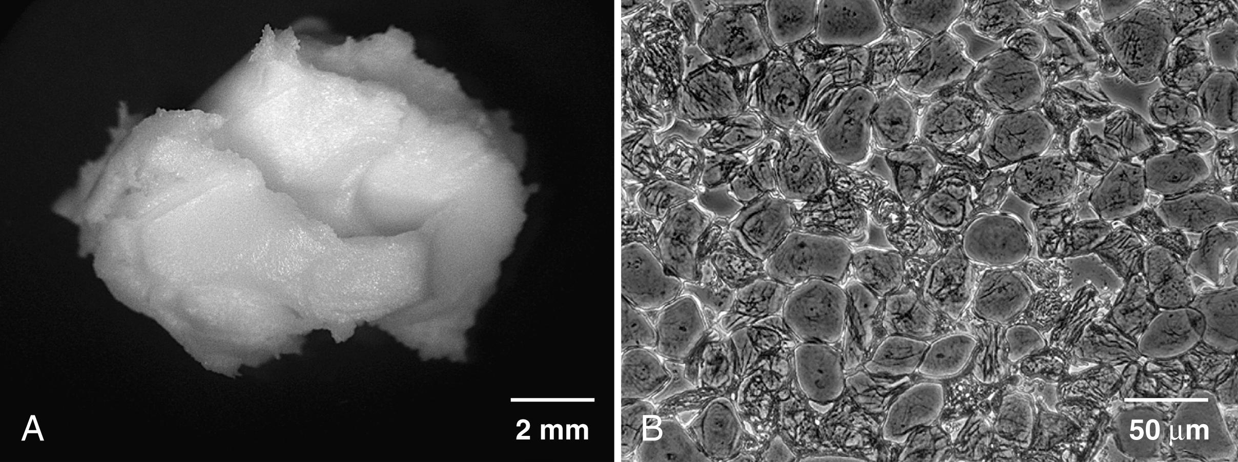 Fig. 44.3, Vernix caseosa. Macroscopically, vernix is a thick, viscous, white paste (A). The phase contrast image of native vernix (B) reveals a dense packing of fetal corneocytes. Vernix consists primarily of thin, hydrated, polygonal, terminally differentiated, fetal corneocytes embedded in a nonlamellar lipid matrix. The cells are heterogeneous in size and structure. Many nuclear ghosts are evident.